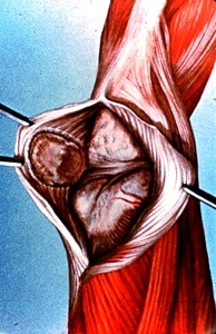 Illustration of surgical exposure of subpatellar region of right knee