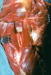 Natural color photograph of dissection of the right arm and shoulder, posterior view, emphasizing the triceps m