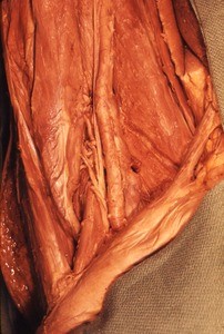 Natural color photograph of dissection of the left thigh, anterior view, showing the femoral triangle, with the great saphenous vein cut and removed