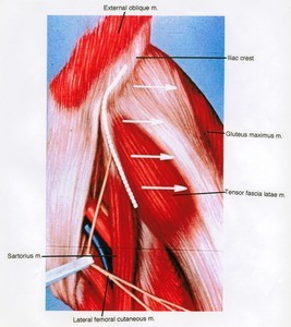 Illustration of the left inguinal region, anterolateral view, showing muscles with the left lateral femoral cutaneous nerve retracted