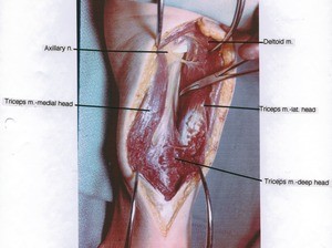 Natural color photograph of left arm, posterior view, showing muscles and the axillary nerve