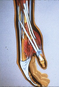 Illustration of right forearm, wrist and hand, digits at rest; semipronated; dissected to show radial digits, including, tendons of extensor pollicis longus and brevis muscles and abductor pollicis longus and brevis, 1st proper dorsal interosseus muscle, extensor hood & radial artery