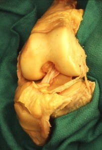 Natural color photograph of dissection of the left knee, anterior view, with the patella reflected inferiorly