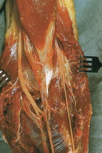 Natural color photograph of dissection of the left cubital fossa, anterior view