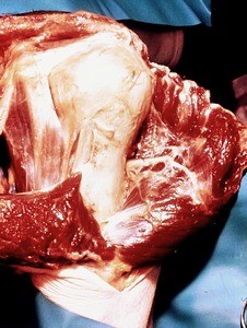 Natural color photograph of dissection of the left shoulder, anterior view, with the deltoid muscle reflected to expose the surgical neck of the humerus and the glenohumeral joint capsule