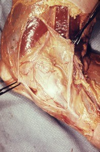 Natural color photograph of dissection of the right knee, medial view