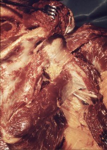 Natural color photograph of dissection of the right shoulder, posterior view, with the deltoid and infraspinatus muscles reflected to reveal the surgical neck of the humerus