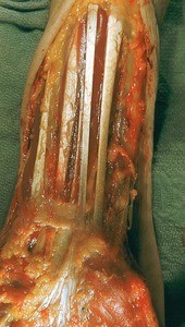Natural color photograph of dissection of the left wrist, anterior view, showing muscles and tendons