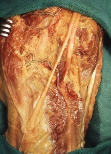 Natural color photograph of dissection of the left popliteal fossa showing the sciatic nerve branching into the tibial and common fibular nerves