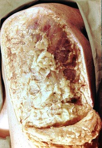 Natural color photograph of dissection of the left shoulder, superior view, with the skin removed to expose the underlying fascia