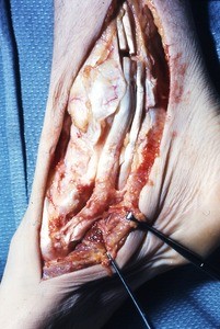 Natural color photograph of dissection of the right ankle, medial view, with the tibialis posterior t. and the flexor digitorum longus t. cut