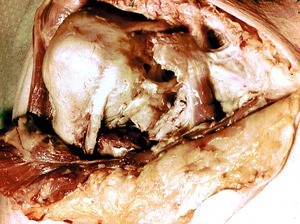 Natural color photograph of dissection of the left shoulder, anterior view, with the deltoid muscle reflected to reveal the tendon of the long head of the biceps brachii running in to the glenohumeral joint capsule