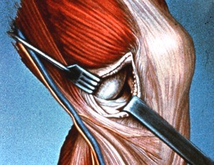 Illustration of surgical approach to interior of left knee joint from medial aspect, exposing the medial tibial condyle and medial meniscus