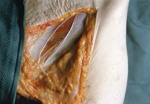 Natural color photograph of superficial dissection of the left inguinal region, anterior view, showing the underlying muscle