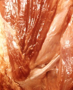 Natural color photograph of left inguinal ligament and left pyramidalis muscle and rectus abdominis sheath