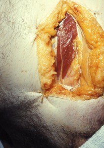 Natural color photograph of dissection of the left inguinal region, anterior view