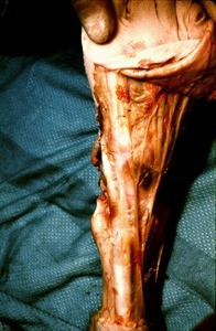 Natural color photograph of dissection of the left lower leg, anterior view, with much of the musculature removed