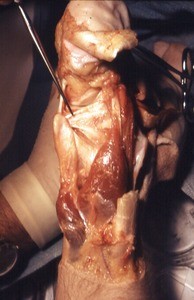 Natural color photograph of dissection of the ankle, posterior view, disarticulated