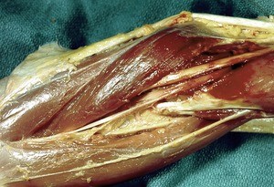Natural color photograph of dissection of the left cubital fossa, anterior view