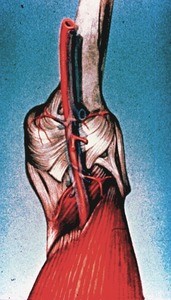 Illustration of posterior surface of right knee showing popliteal artery and its genicular branches in relation to collateral ligaments and femur