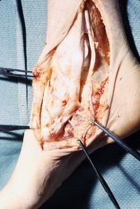 Natural color photograph of dissection of the right ankle, medial view