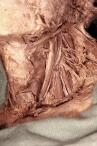 Natural color photograph of dissection of the left side of the neck, anterolateral view, showing the left common carotid artery bifurcating to become the right external and internal carotid arteries