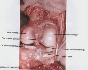 Natural color photograph of left knee, posterior view, showing bones, muscle, cartilage and ligament with popliteus muscle reflected