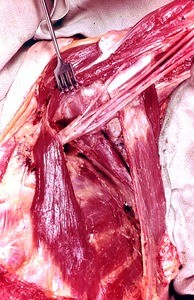 Natural color photograph of dissection of the left axilla, anterior view, showing the brachial plexus