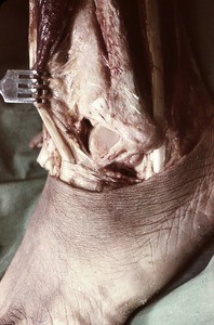 Natural color photograph of dissection of the left ankle, lateral view, emphasizing the articulation of the tibia and fibula and the anterior tibiofibular ligament between them