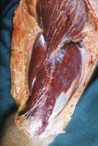 Natural color photograph of dissection of the arm and shoulder, lateral view