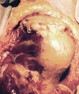 Natural color photograph of dissection of the right shoulder, lateral view, showing muscle and bone structure of the rotator cuff