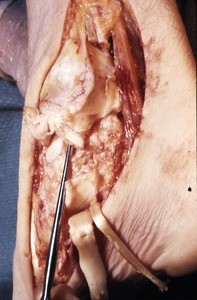 Natural color photograph of dissection of the the right ankle, medial view, with the tibialis posterior t. and the flexor digitorum longus t. cut and reflected