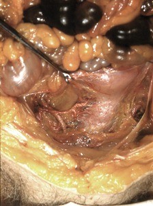 Natural color photograph of dissection of the pelvic cavity, anterior view, with the uterus retracted to expose the vesicouterine pouch and the vessels associated with the uterus