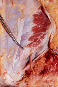 Natural color photograph of dissection of the abdominal wall, anterior view, showing the internal abdominal oblique m. with the spermatic cord exiting the deep inguinal ring