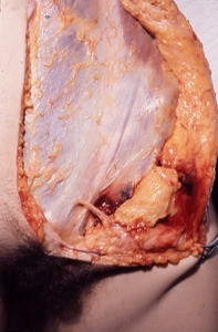 Natural color photograph of dissection of the abdominal wall, anterior view