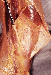 Natural color photograph of dissection of the left knee, medial view