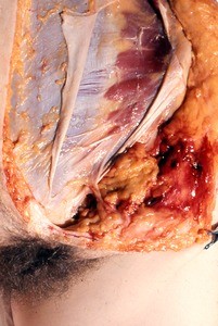 Natural color photograph of the left external abdominal oblique m., anterior view and rectus sheath