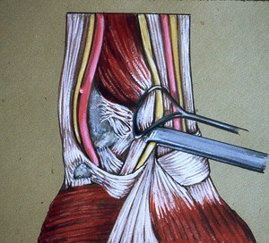 Illustration of palmar aspect of left wrist, with median nerve and tendons of flexor digitorum profundus and flexor digitorum superficialis retracted to show ulnocarpal articulation; also present: ulnar artery and nerve