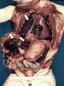 Natural color photograph of dissection of a fetus, anterior view, showing the superior vena cava and other internal organs