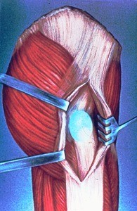 Illustration of surgical exposure of right hip joint, lateral aspect; blue oval indicating locus of iliopectineal bursa; iliotibial tract incised and retracted
