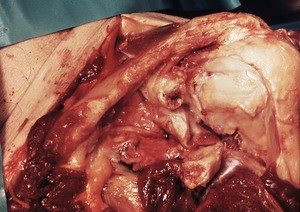 Natural color photograph of dissection of the left shoulder, anterior view, with the glenohumeral joint capsule opened to expose the tendon of the long head of the biceps brachii muscle running over the head of the humerus