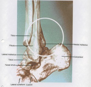 Illustration of dissection of the right ankle joint, medial view, emphasizing the medial malleolus