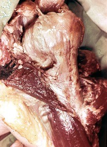 Natural color photograph of dissection of the left shoulder, anterior view with the deltoid muscle reflected to expose the glenohumeral joint capsule and surgical neck of the humerus