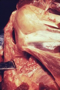 Natural color photograph of dissection of the left shoulder, anterior view, with the deltoid muscle reflected to expose the underlying bones, muscles, nerves, and tendons