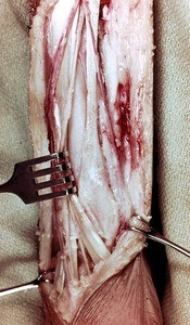 Natural color photograph of dissection of the forearm, with structures retracted to expose the palmar aponeurosis