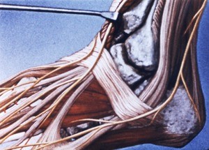 Illustration of left ankle and foot, dorsolateral aspect, emphasizing the inferior extensor retinaculum and exposing the fibular lateral malleolus