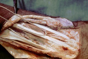 Natural color photograph of dissection of the left forearm, showing tendons