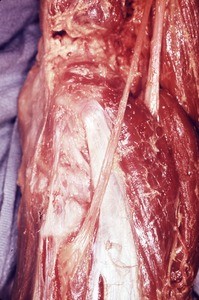 Natural color photograph of dissection of the popliteal fossa, showing the common fibular nerve as it courses anteriorly, inerior to the fibular head