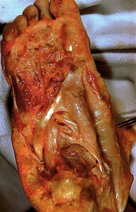 Natural color photograph of dissection of the plantar surface of the right foot