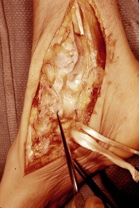 Natural color photograph of dissection of the right foot, medial view, with the tibialis posterior and flexor digitorum longus tendons reflected